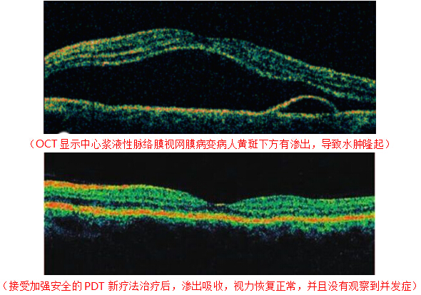 中心性視網膜炎黃斑水腫
